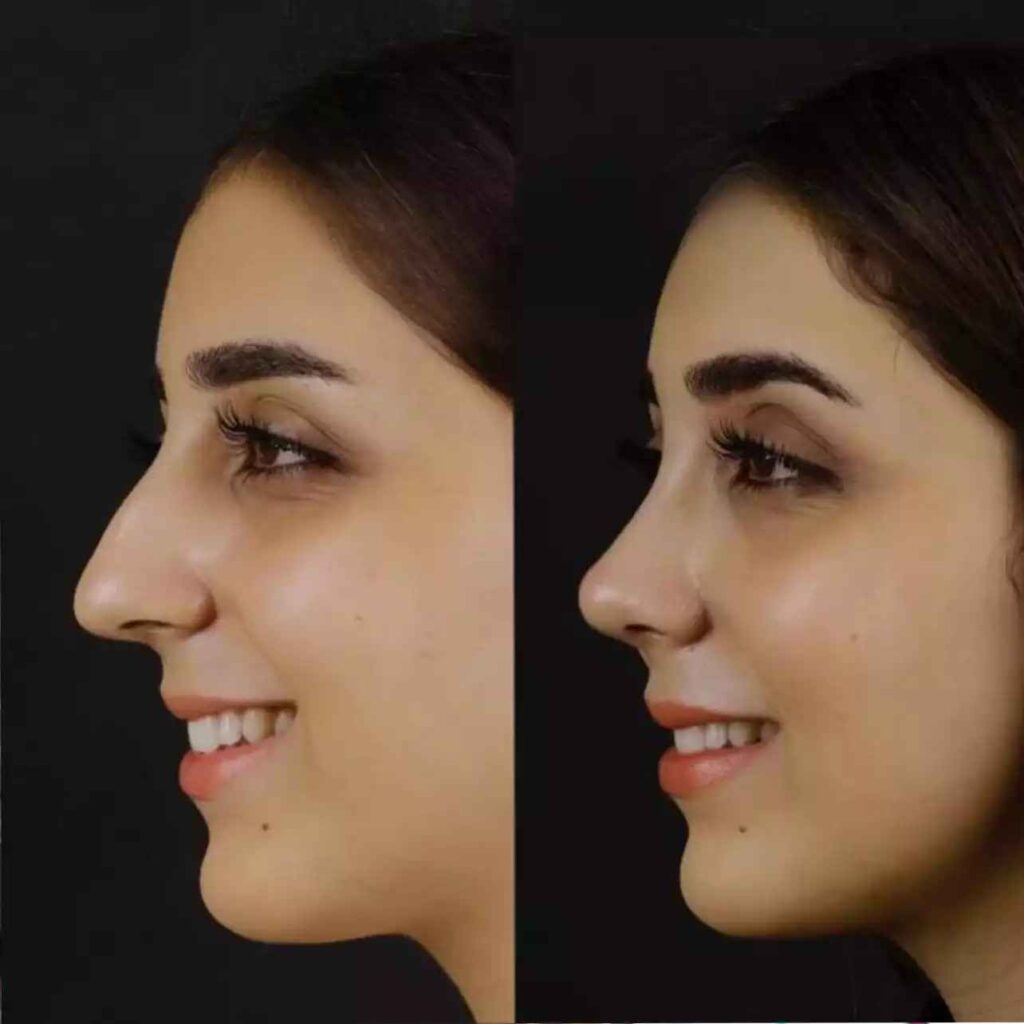 Septoplasty in Dubai
