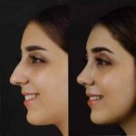 Septoplasty in Dubai