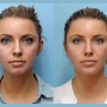 Elevate Facial Definition Effortlessly Through Thread Lift Treatments in Dubai Experience