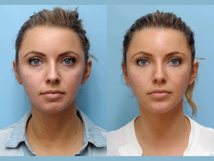 Elevate Facial Definition Effortlessly Through Thread Lift Treatments in Dubai Experience