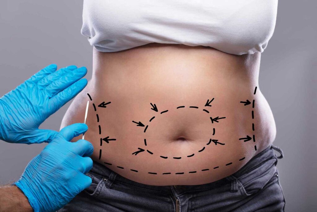 Preparing for Your Tummy Tuck Dubai Surgery: Step-by-Step Guide