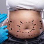 Preparing for Your Tummy Tuck Dubai Surgery: Step-by-Step Guide